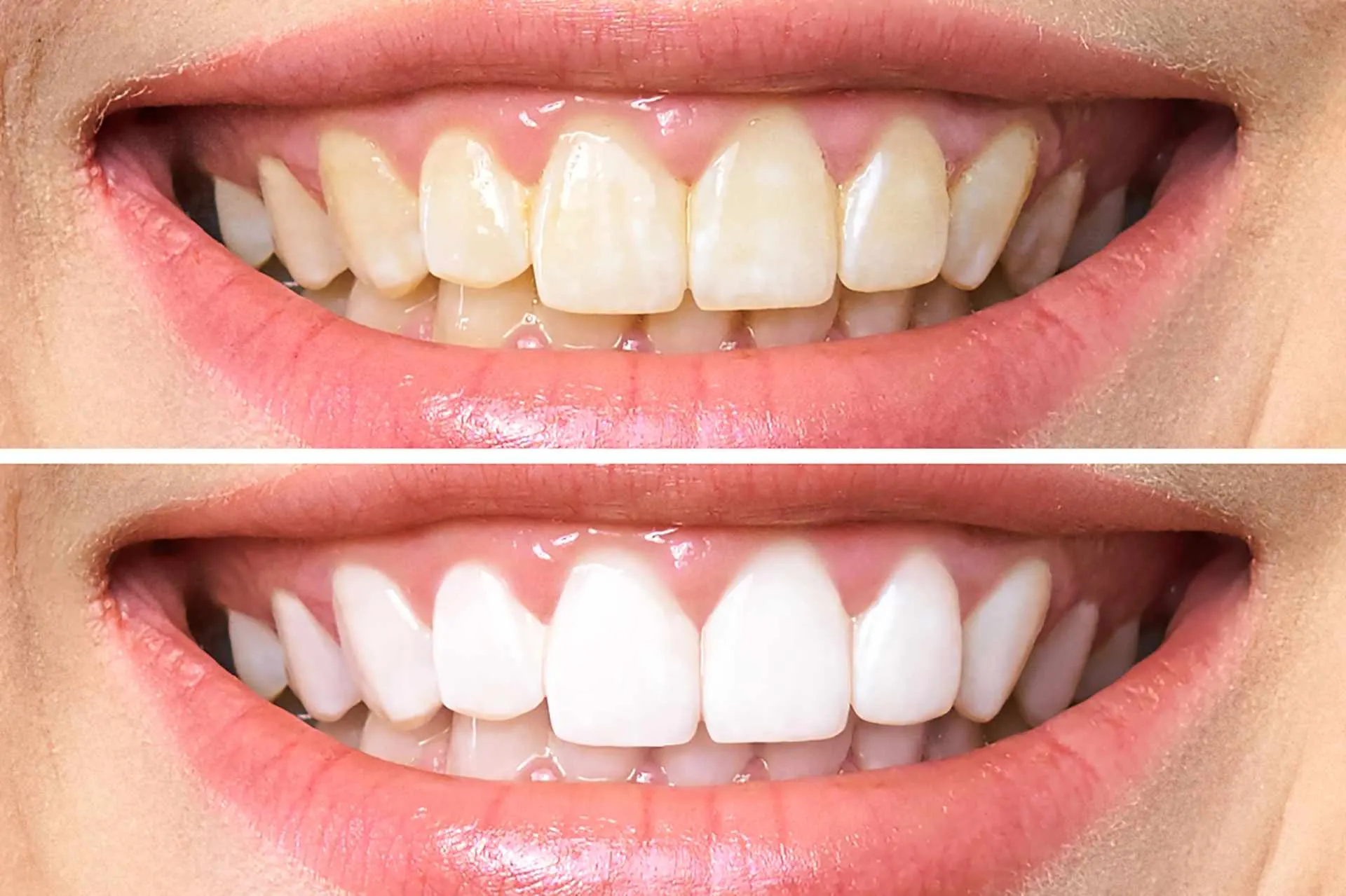 33077 at home teeth whitening