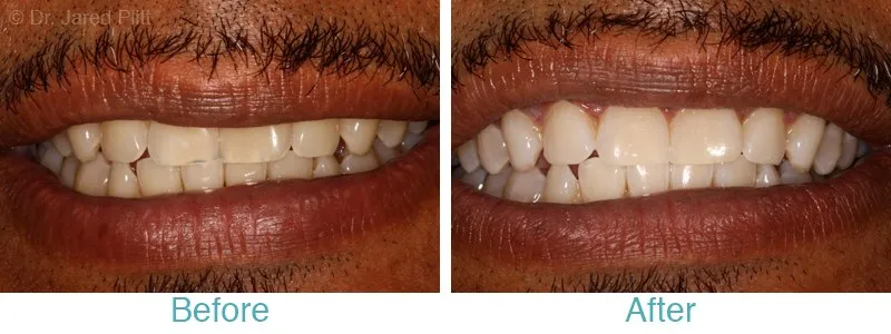 33077 teeth whitening aftercare