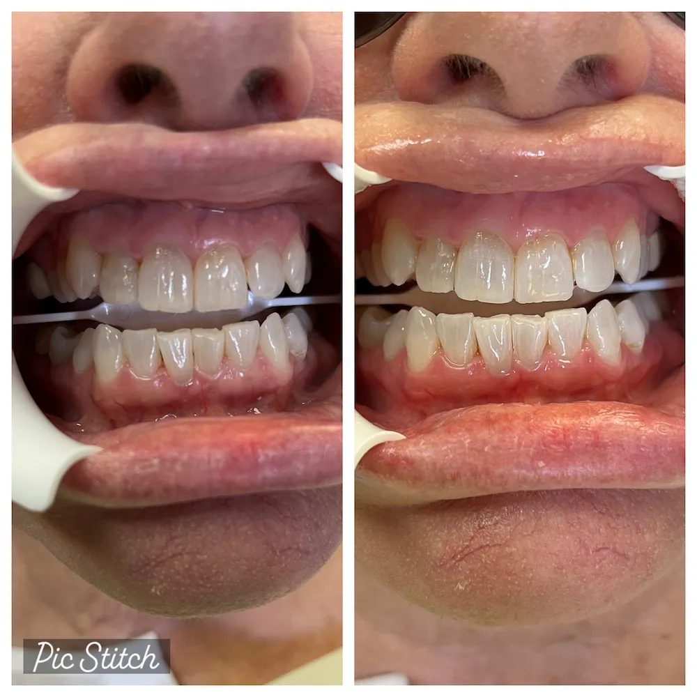 33078 at home teeth whitening