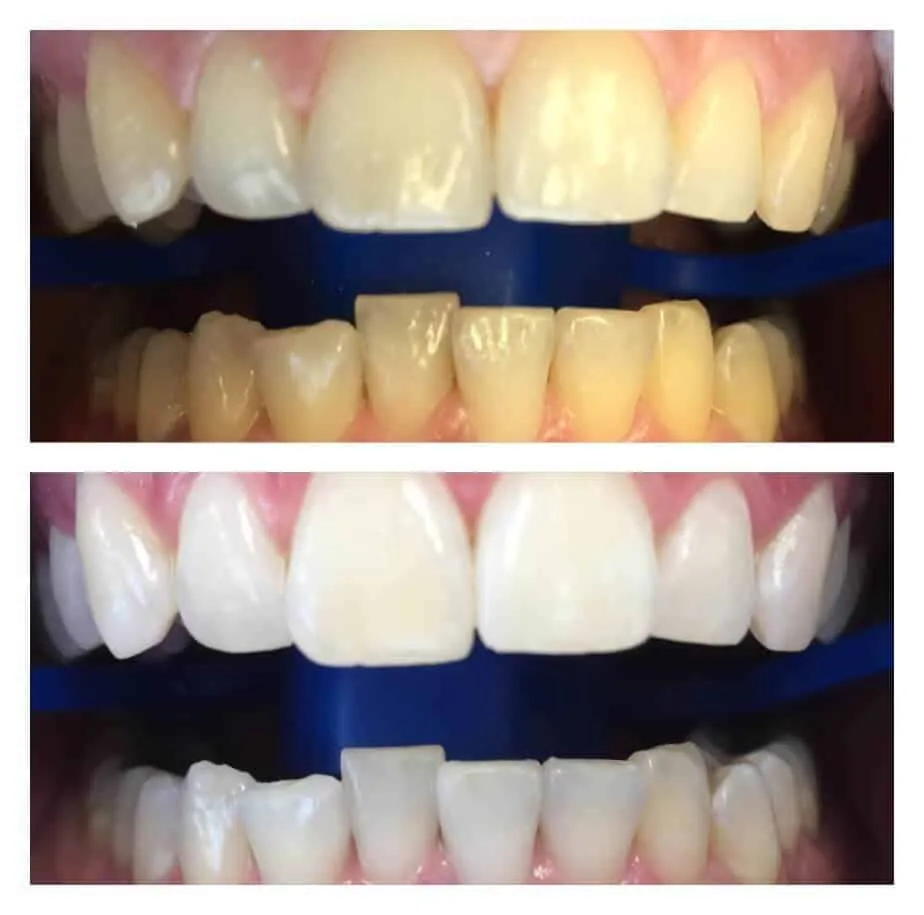33078 cape coral teeth whitening confidence