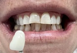 33078 in office teeth whitening
