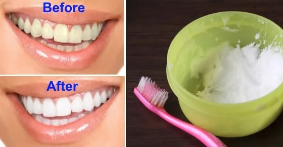 33080 teeth whitening pain 1