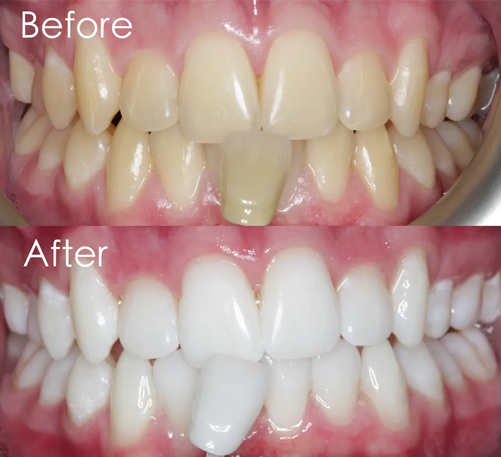 33084 ktp laser teeth whitening cost factors