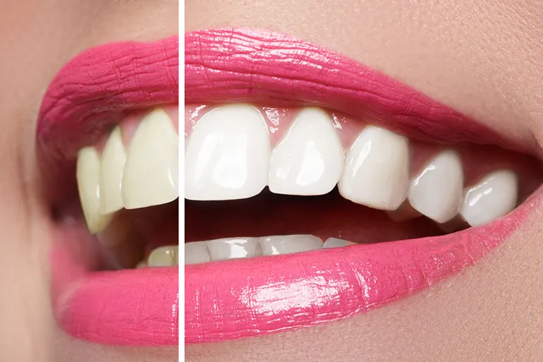 33088 whitening toothpaste
