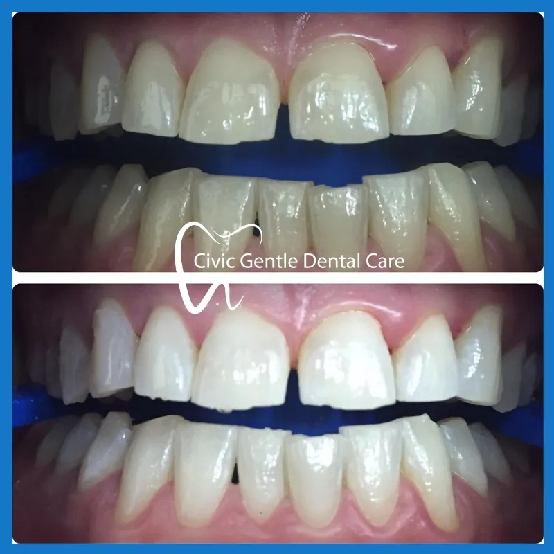 33089 teeth whitening results