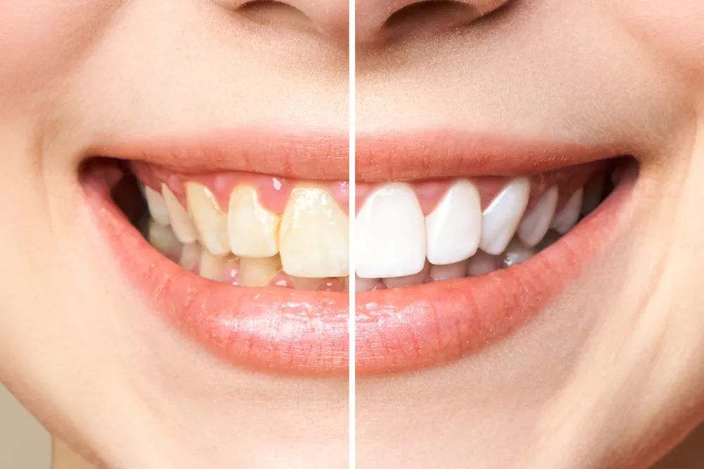 /img/33090-diy-teeth-whitening.webp