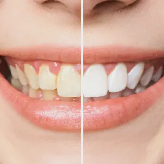 /img/33090-diy-teeth-whitening.webp