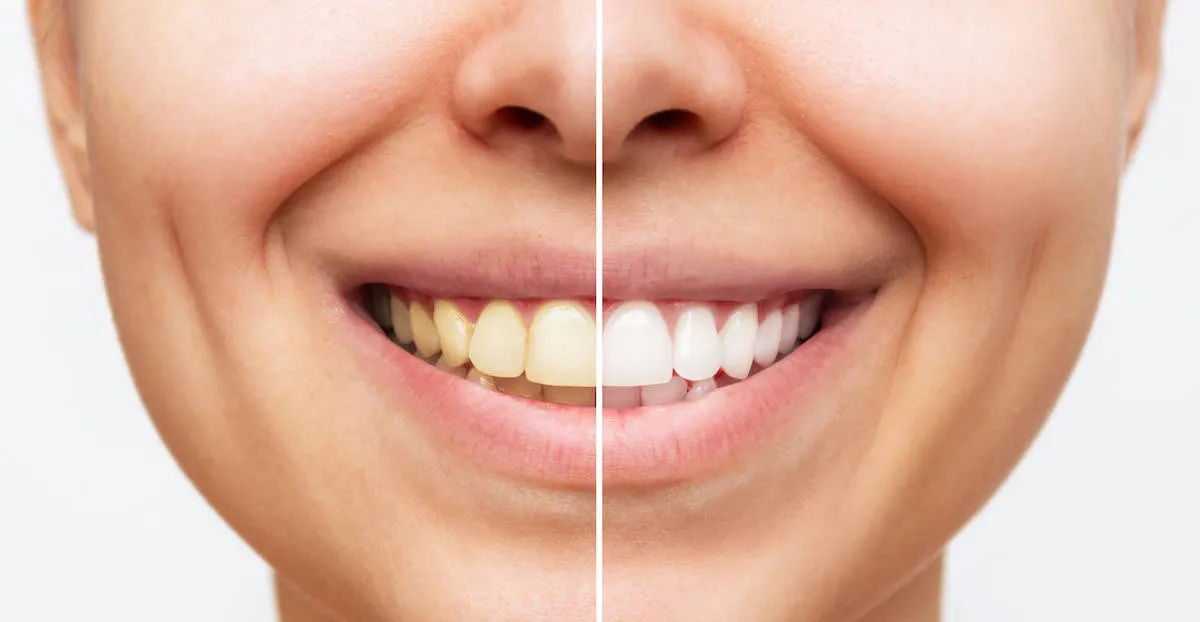 33090 professional teeth whitening