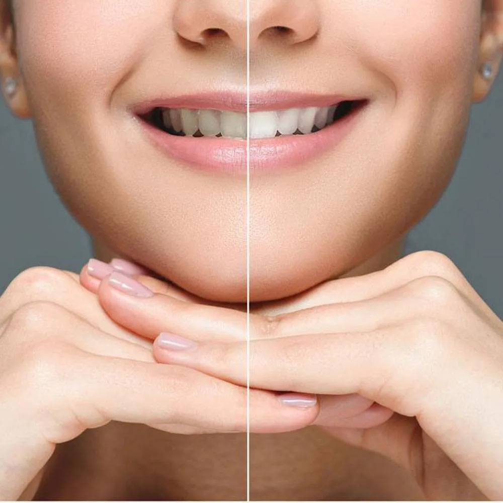 33090 teeth over whitening