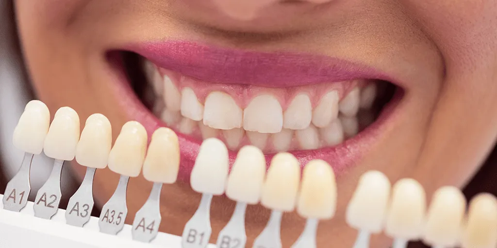 33094 in office whitening