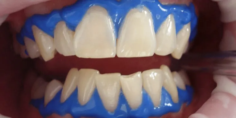 33094 sensitivity toothpaste