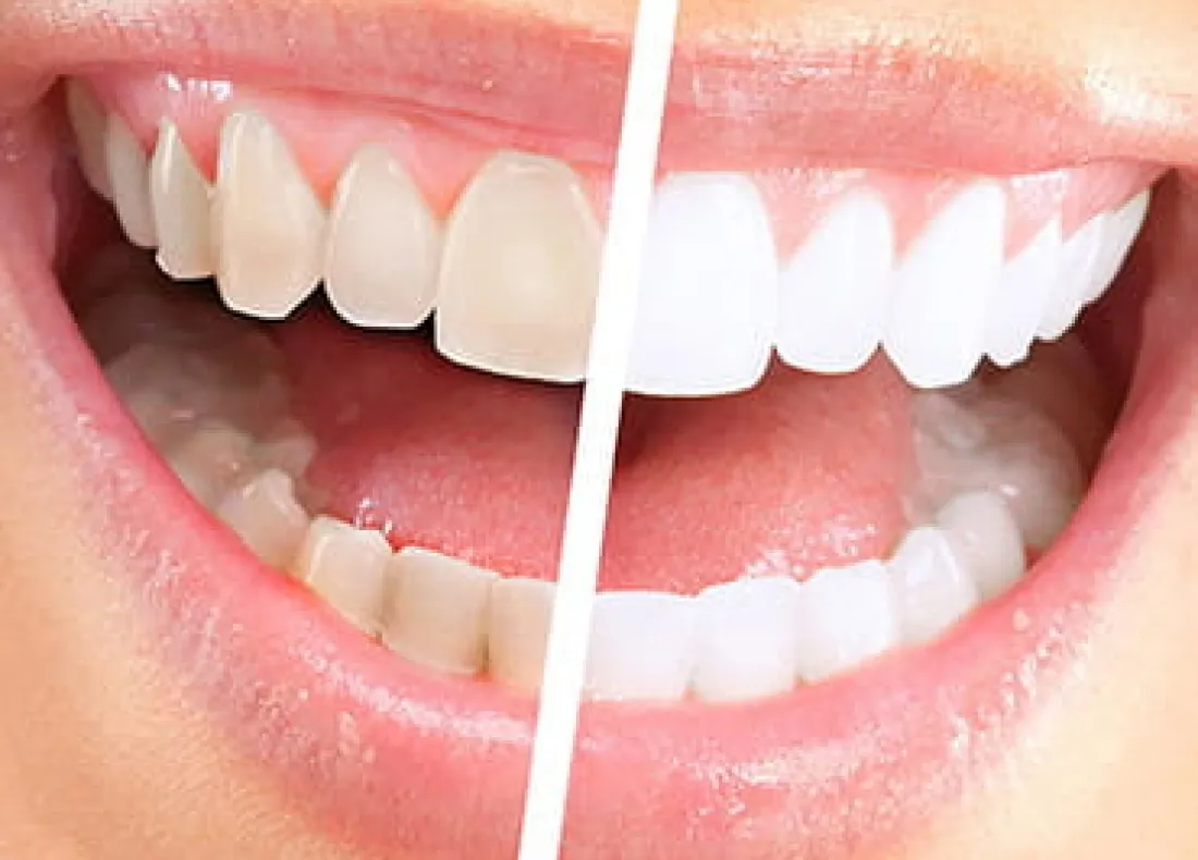33094 teeth whitening sensitivity main