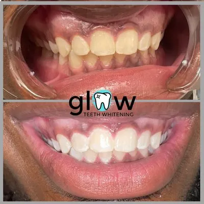 33096 in office teeth whitening