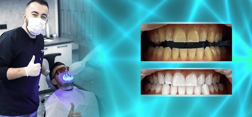 33096 teeth whitening popular