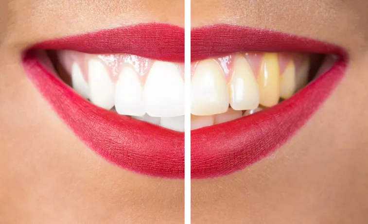 33096 teeth whitening types