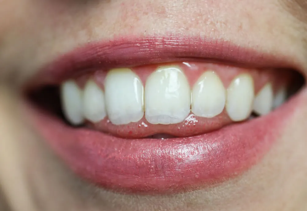 33109 apple teeth cleaning