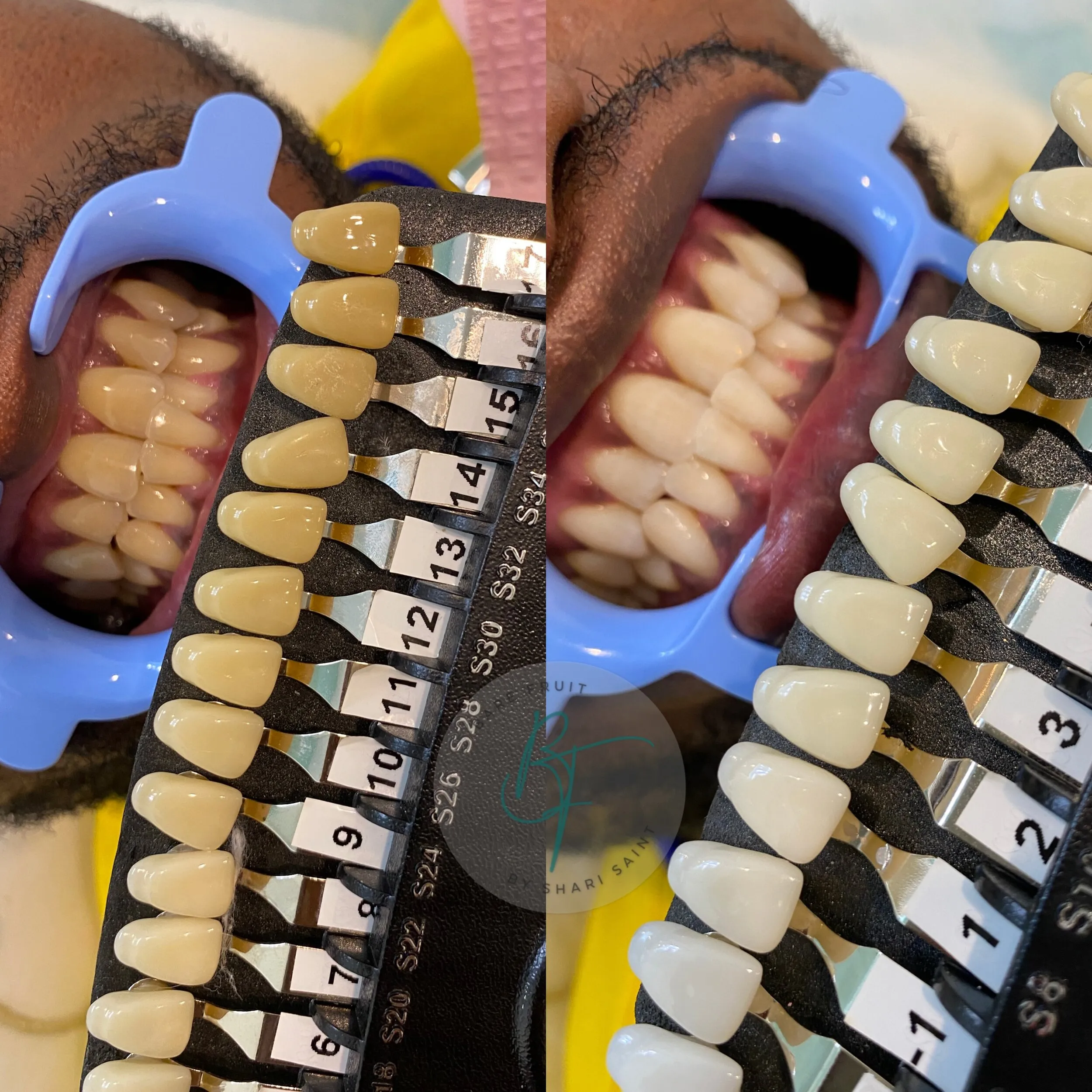33109 fruit teeth whitening header