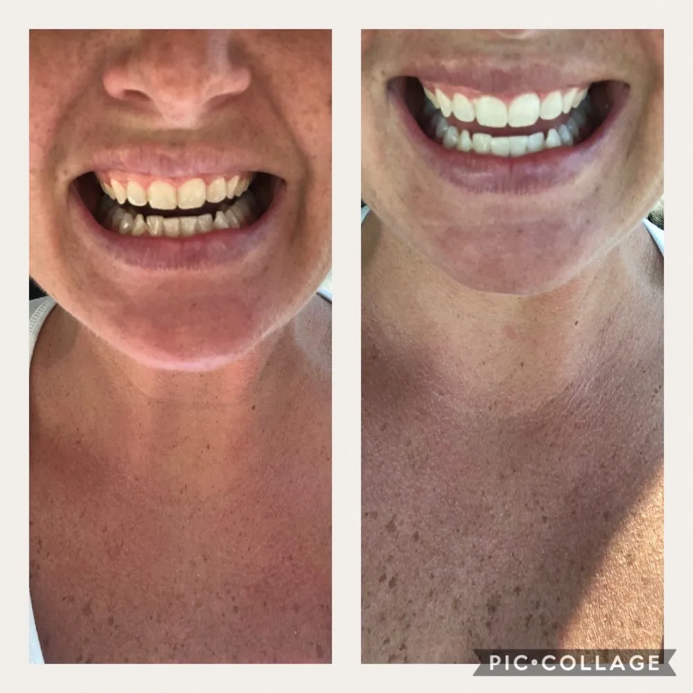 33110 in office teeth whitening