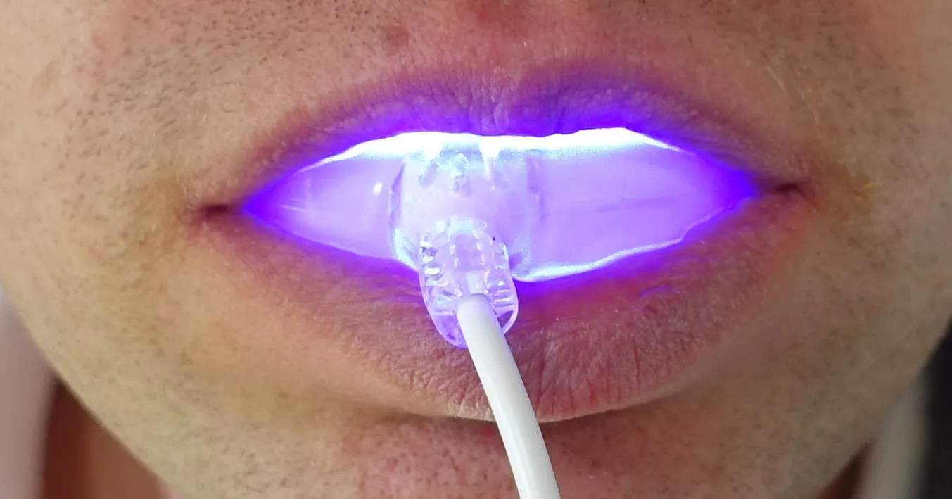 33114 uv whitening dangers teeth image2