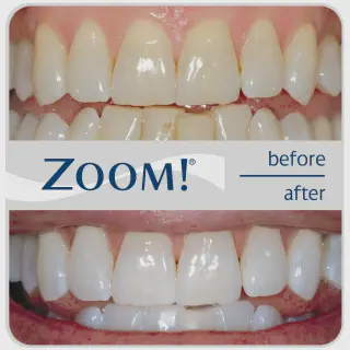 /img/33119-zoom-whitening-alternatives.webp