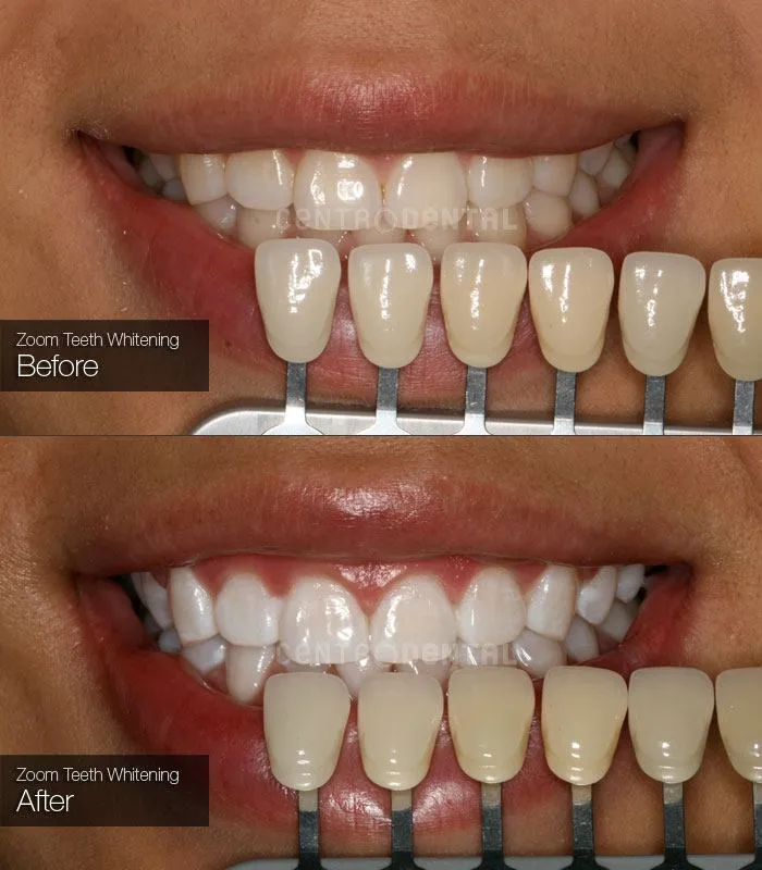 33119 zoom whitening benefits