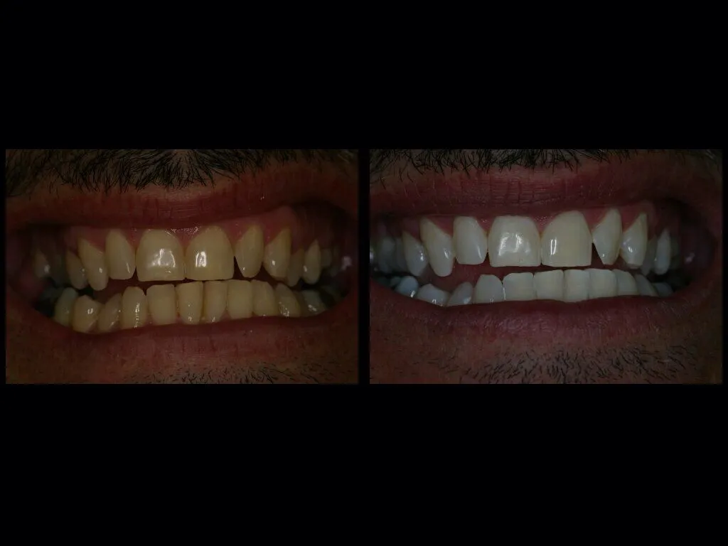 33119 zoom whitening care