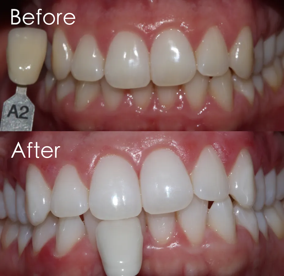 33119 zoom whitening cost