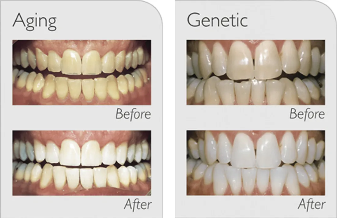 33119 zoom whitening results
