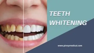 33124 teeth whitening philippines