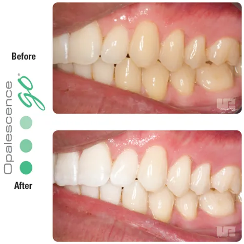 /img/33130-professional-teeth-whitening.webp