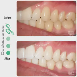 /img/33130-professional-teeth-whitening.webp