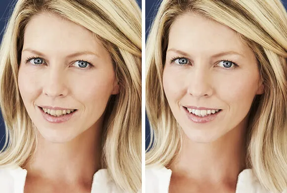33132 before after teeth whitening