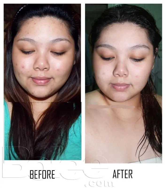 33133 skin whitening atlanta 2