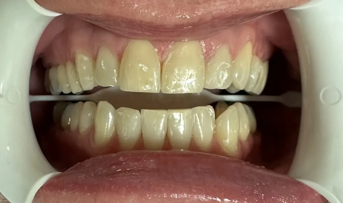 33135 teeth whitening before after