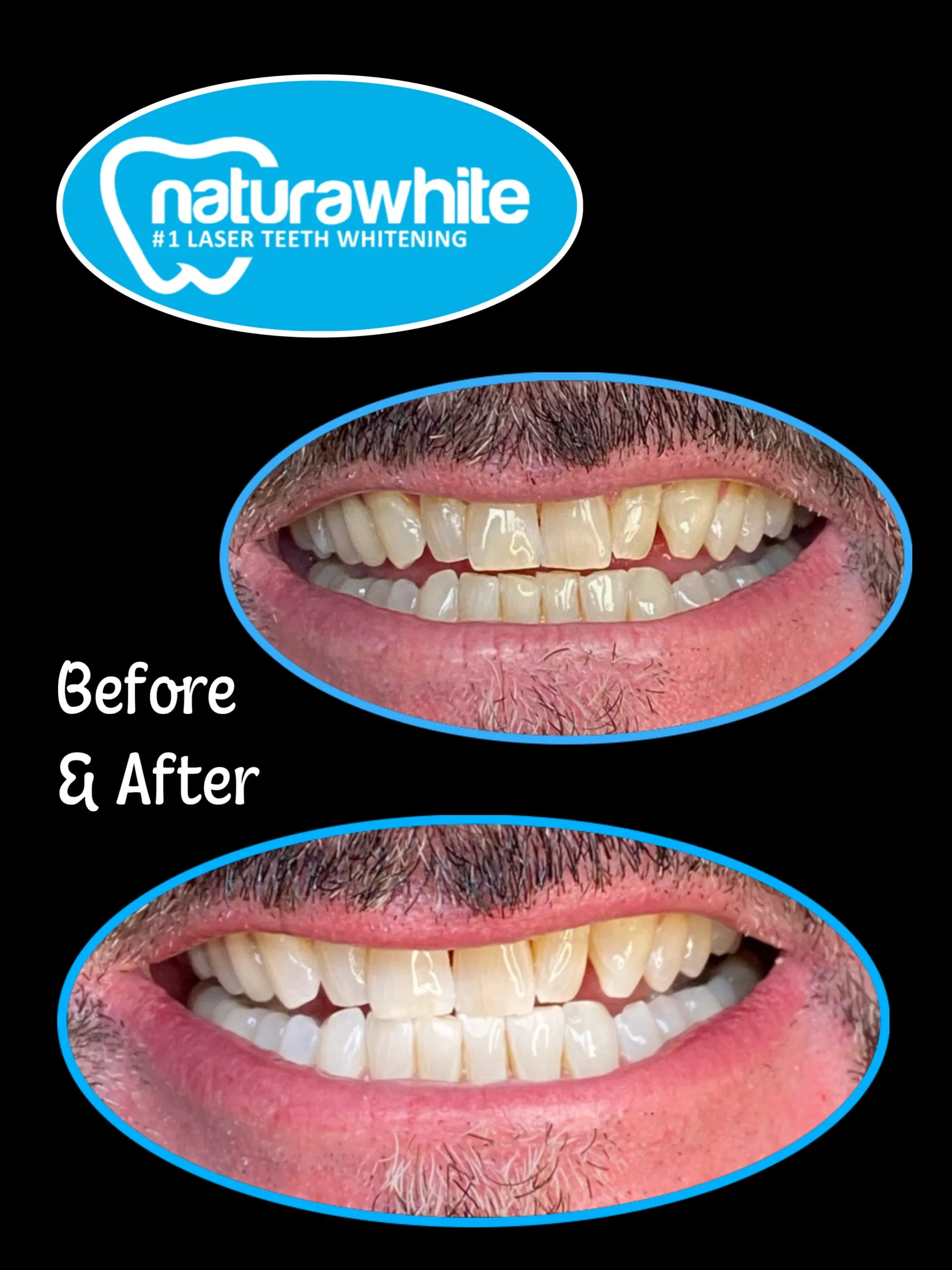 33139 laser whitening carlisle dental clinic