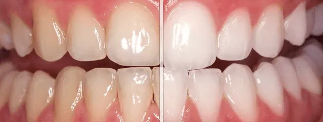 33141 in office teeth whitening