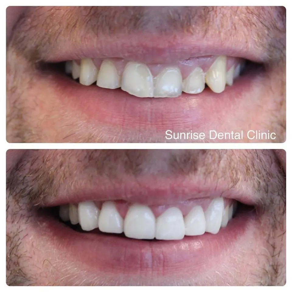 33143 whitening strips ingredients