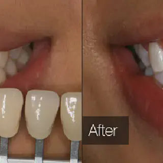 /img/33145-maintaining-teeth-whitening.webp