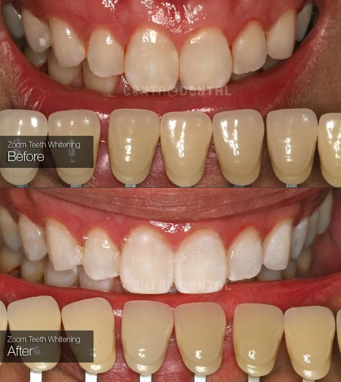 33145 professional consultation teeth whitening