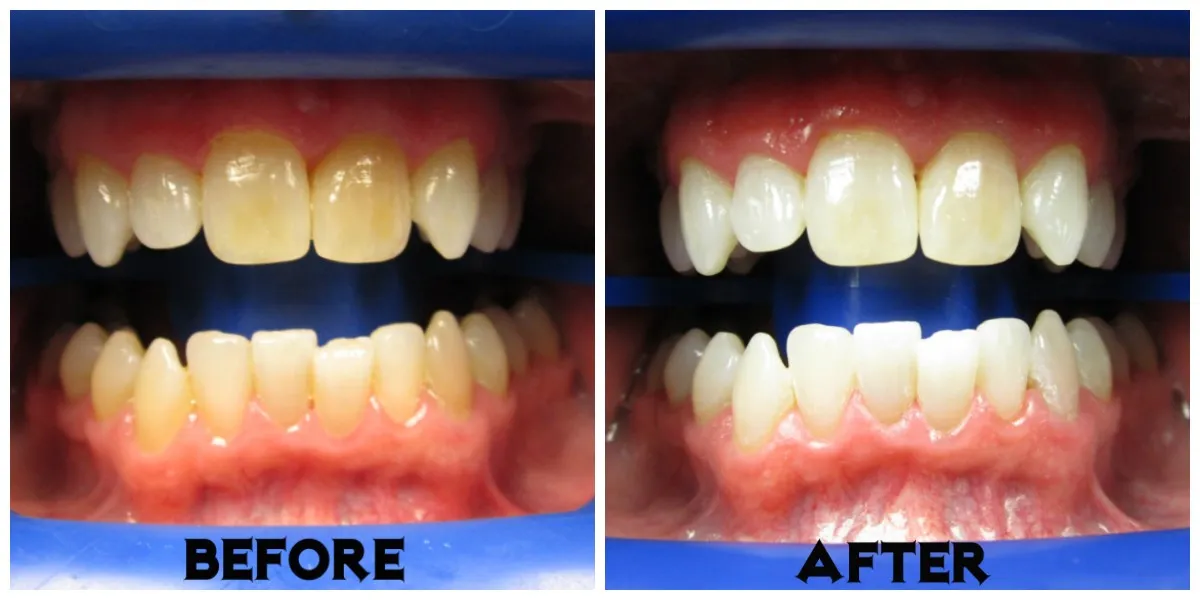 33145 teeth whitening aftercare