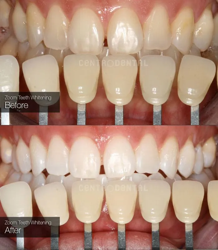 33145 teeth whitening procedure