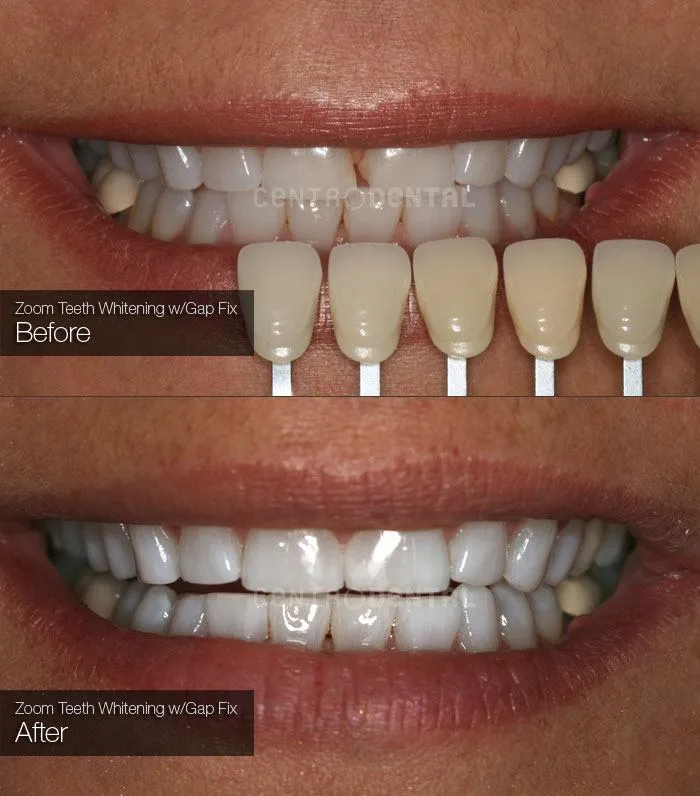 33145 zoom teeth whitening process