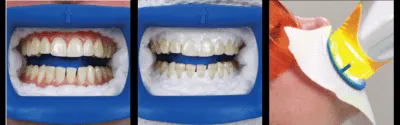 33152 post pregnancy teeth whitening