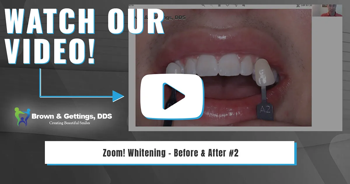 33152 safe teeth whitening alternatives