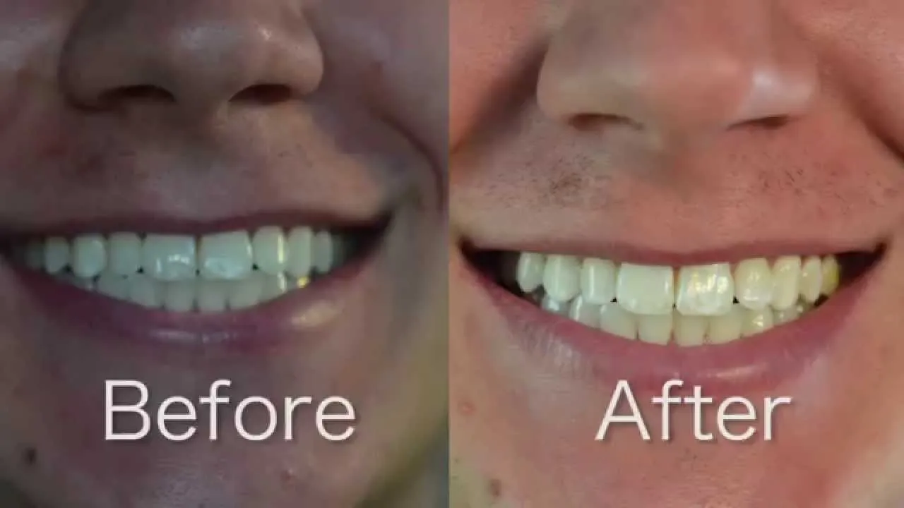 33153 choosing crest 3d white strips