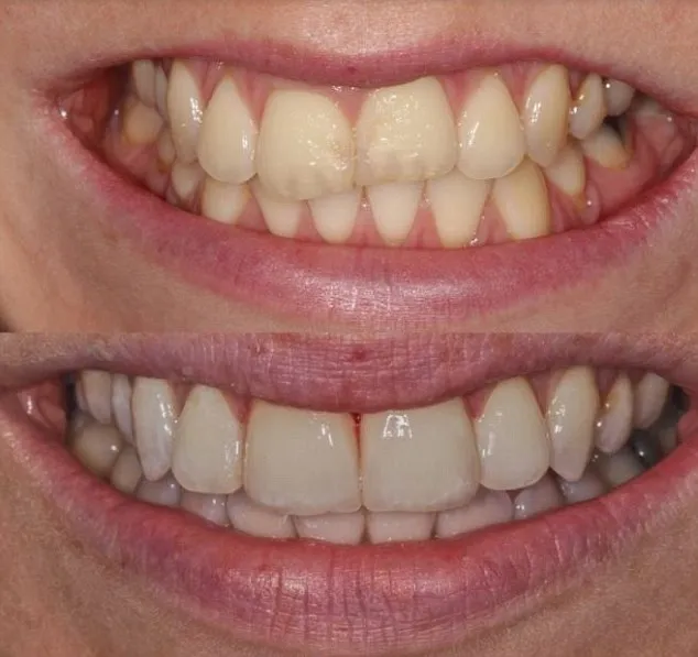 33154 abrasive teeth whitening