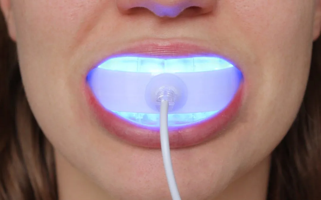 33160 laser teeth whitening