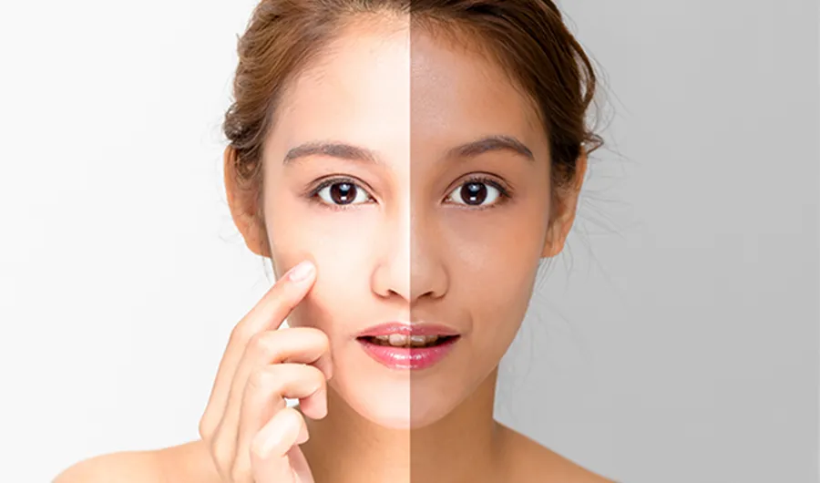 33161 skin whitening treatment overview