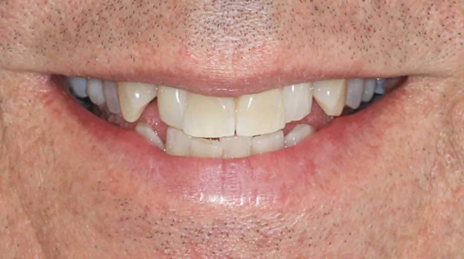 33162 invisalign and teeth whitening 3