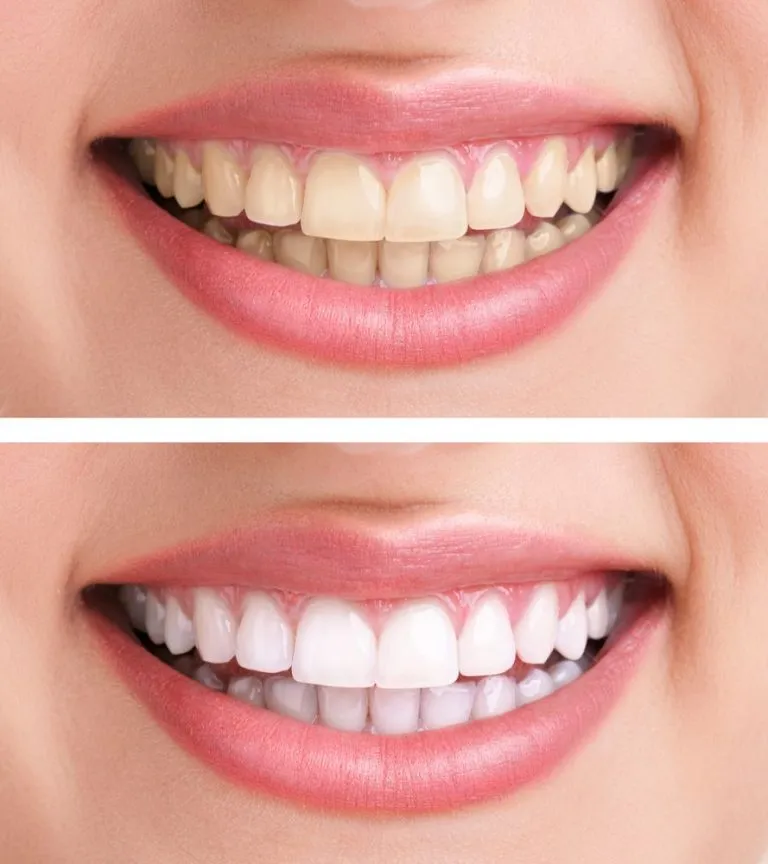 33162 invisalign and teeth whitening 5